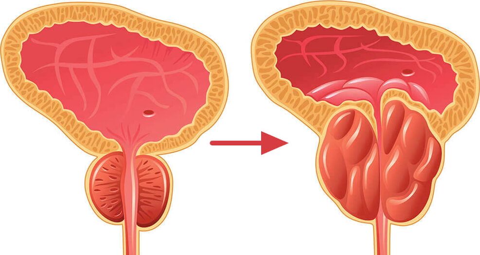 Prostata normale e infiammata