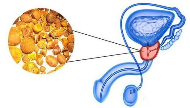 Calcolato nella ghiandola prostatica