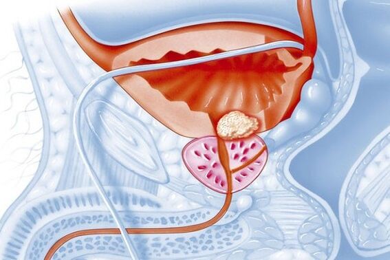 Processo infiammatorio nella prostata