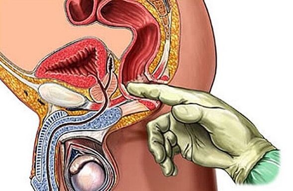 Massaggio prostatico per curare la prostatite