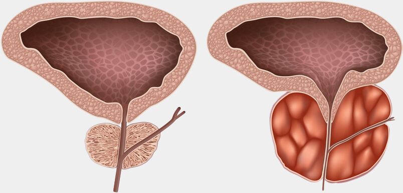 prostata sana e infiammata con prostatite