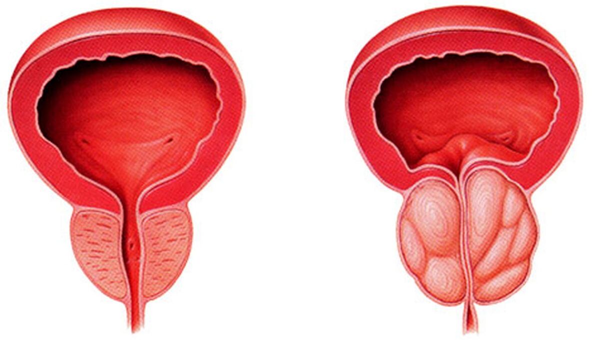 prostata sana e infiammata con prostatite