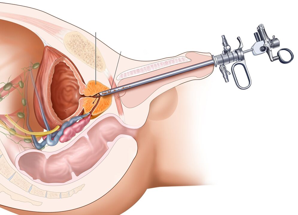 La resezione transuretrale della prostata consente di rimuovere le parti interessate dell'organo