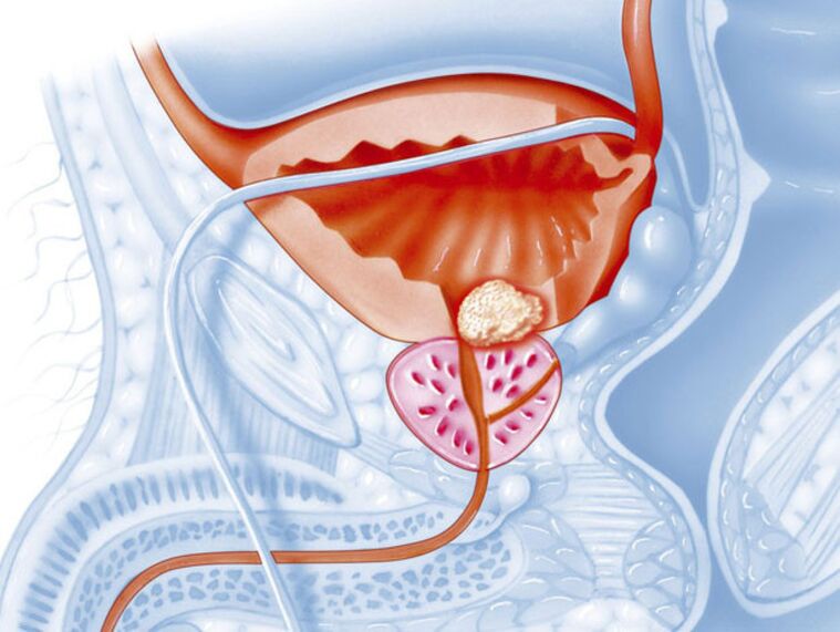 Con la prostatite cronica, il lume dell'uretra si restringe, il che rende difficile il drenaggio dell'urina. 