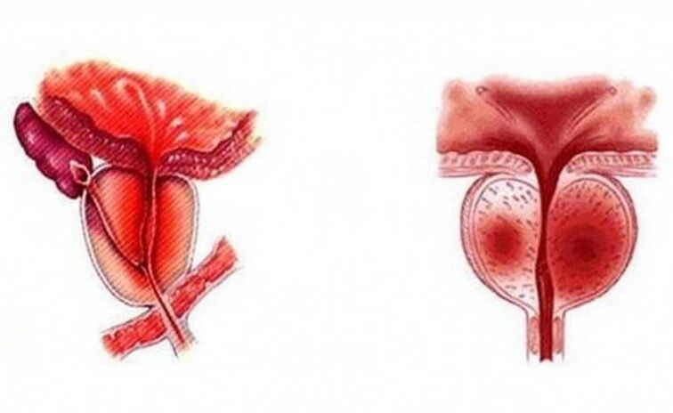 Infiammazione acuta della prostata che può diventare cronica